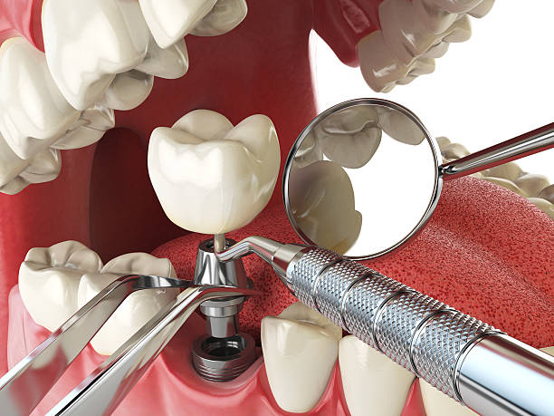 Best Knocked-Out Tooth (Avulsed Tooth) Treatment in Malvern, IA